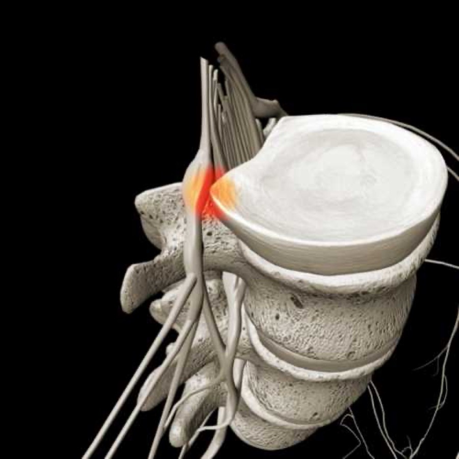 Illustration of a herniated disc