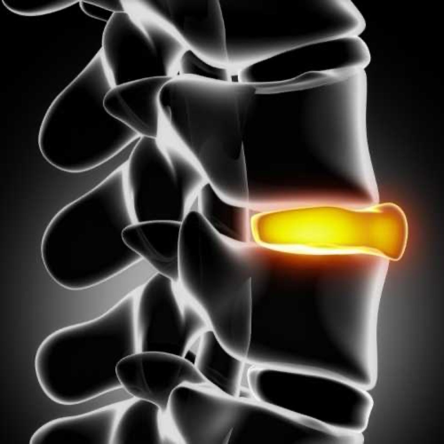 Illustration of a ruptured disc